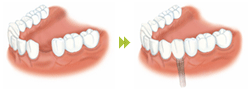 単独歯：歯を１本失った方