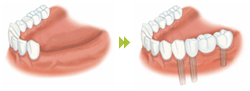 複数歯：複数の歯を失った方